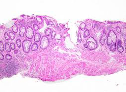 Radiation Injury